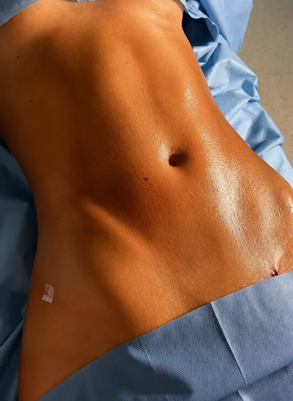 Contorno abdominal depois do procedimento
