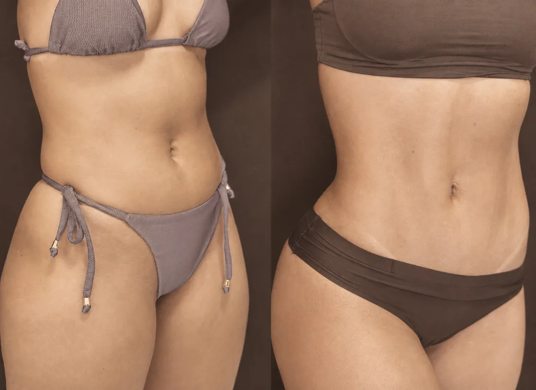 Antes e depois — contorno abdominal, vista oblíqua