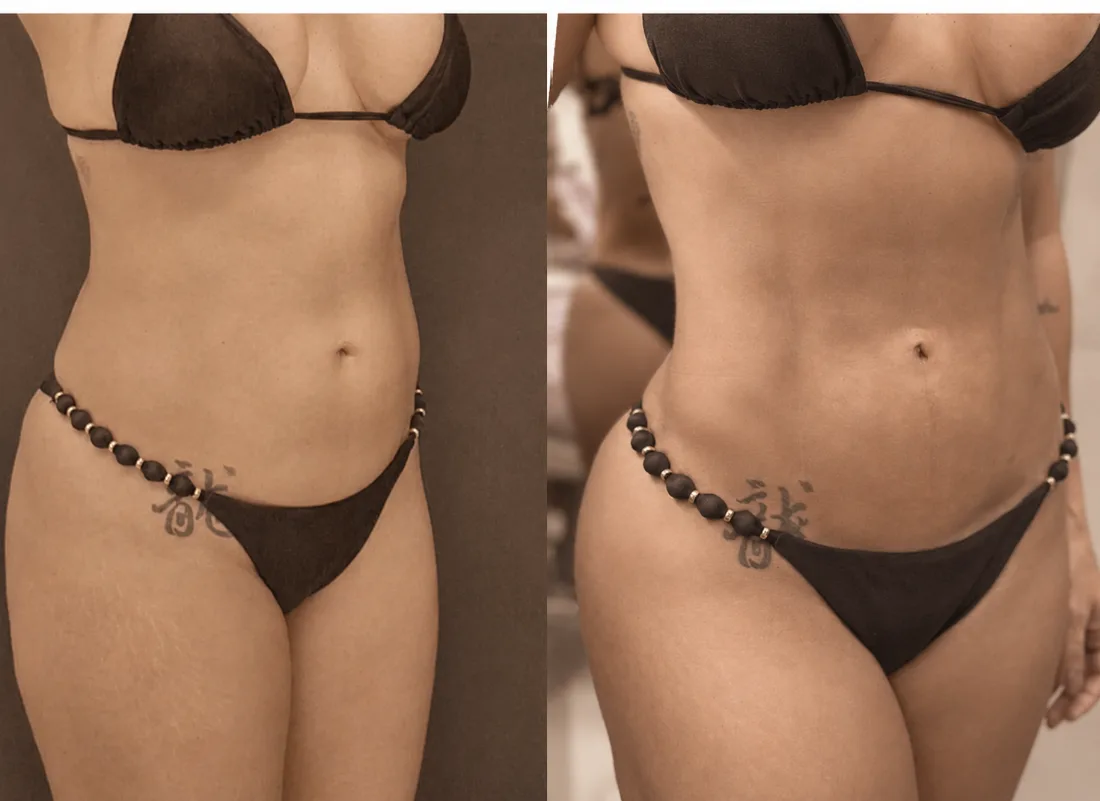 Antes e depois — contorno abdominal, vista frontal